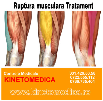 ruptura musculara picior pulpa tot despre leziuni la genunchi